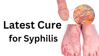 Latest treatment of syphilis How to cure any stage of syphilis [upl. by Reginnej291]