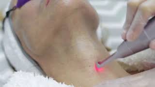 LUCID QPTP Carbon Peeling Treatment [upl. by Ause]