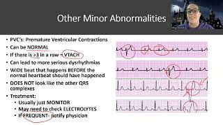 Adult MedSurg Dysrhythmia NEW Lecture PVCsPACs [upl. by Anaitsirhc]