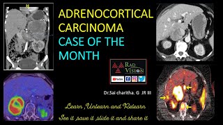 Adrenocortical carcinoma CASE OF THE MONTH [upl. by Oderfigis]