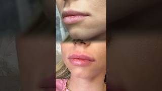 Augmentarea buzelor cu acid hialuronic Lip augmentation with hyaluronic acid [upl. by Far]