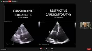 Constrictive Pericarditis amp Restrictive Cardiomyopathy Echo Update [upl. by Yelruc409]