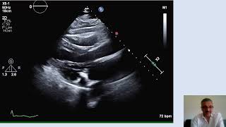 Cardiac tamponade Part 2 Detecting and differentiating pericardial effusion from pleural effusion [upl. by Ahsineb]