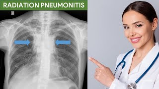 Radiation Pneumonitis [upl. by Amleht]