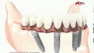 Fix Loose and Uncomfortable Dentures [upl. by Pedaiah]