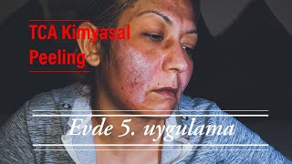 TCA Kimyasal Peeling 4 ve 5 seans [upl. by Aitas]