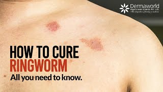 Type of Ringworm  How to cure Ringworm  All you need to know about Ringworms  Dr Rohit Batra [upl. by Eluk]