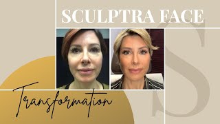 Sculptra Before amp After  My Review on the NonSurgical Facelift  Dominique Sachse [upl. by Seyah]