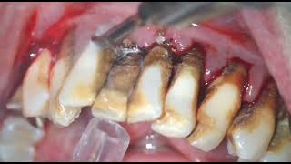Scaling and root planing [upl. by Dyrraj90]