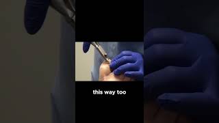 Discover the technique of thinning out a thickened nail for better comfort NailCare Podiatry [upl. by Pilihp]