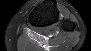 Plantaris musle rupture [upl. by Ydeh]