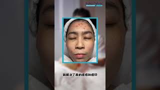 【顾客效果见证】3个月解决了严重痘痘问题！  New York Skin Solutions 护肤专家 专治各种肌肤问题：痘痘、黑斑、皱纹、敏感肌等等 [upl. by Anerac856]