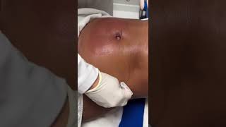 Coolsculpting  Clínica Luciana Hitomi procedimentosesteticos [upl. by Einnor644]