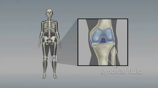 Osteoarthritis of the knee Choosing the right pain medicine [upl. by Eeltrebor827]