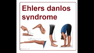 Ehlers Danlos Syndrome  2024 [upl. by Macfarlane]