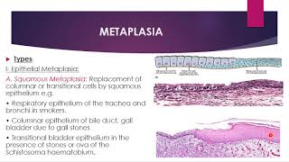 Disorders of growth and neoplasia  metaplasia dysplasia and carcinoma in situ [upl. by Potts143]