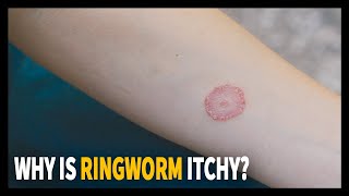 All you need to know about Ringworm Why is it itchy [upl. by Nnairrehs]