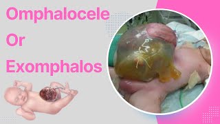 Omphalocele  Exomphalos  Causes Symptoms Diagnosis Treatment Pathology [upl. by Riamo]