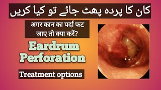 Perforated eardrum treatment  Ruptured eardrum  Kaan ka parda phat jaye to kya kare [upl. by Eldoria]