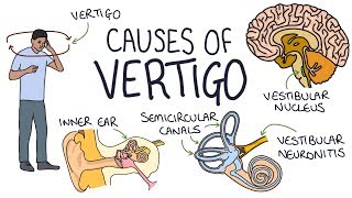 Understanding the Causes of Vertigo [upl. by Eednyl57]