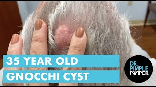 A 35 Year Old Gnocchi Pilar Cyst [upl. by Heiner558]