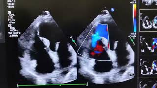 VENTRICULAR SEPTAL REPTUREVSR [upl. by Asamot]