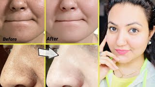 कितने भी मुश्किल Blackheads Whiteheads कील सफेद दाने हों follow करें ये 5 steps और पाएँ चमकदार skin [upl. by Gnuhn]