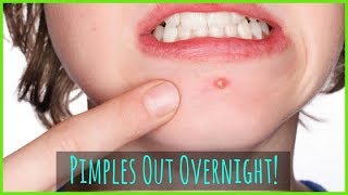 How To Get Rid Of Pimples  Acne Overnight Fast [upl. by Weatherby649]