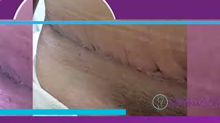 Abdominoplastia  Proceso de cicatrización [upl. by Anitneuq]