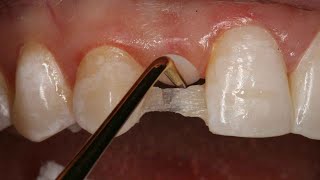 Direct Resin Bonded Bridge  Dental Online Training [upl. by Bonnell]