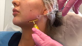 Jawline Filler London  by Dr Leah Totton [upl. by Letniuq427]