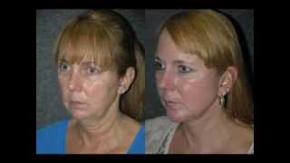 Facelift and Neck Lift Before and After Top NYC Plastic Surgeon Doctor Andrew Jacono facelift [upl. by Estis]