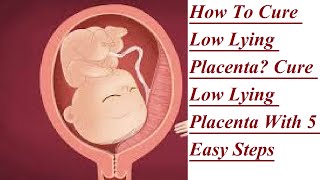 Placenta Previa Natural Treatment Cure Low Lying Placenta With 5 Easy Steps [upl. by Aizat116]