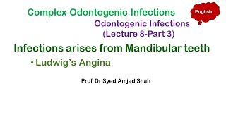 Ludwig’s Angina  Sublingual  Submandibular  Submental Spaces Infections [upl. by Yanat]