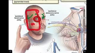 Millard Gubler syndrome  Ventral pontine syndrome  made super easy [upl. by Belter419]