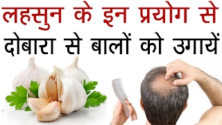 दोबारा से बालों को उगायेंगंजेपन का रामबाण इलाज लहसुन से  Grow Your Hair With Garlic In Hindi [upl. by Vel]