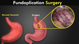 How Fundoplication Procedure Is Performed To Treat GERD or Acid reflux [upl. by Irtak]