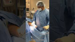 Lipedema Liposuction of Arm and Forearm  Dr Boris Volshteyn [upl. by Keever]