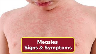 The 3 Warning Signs of Measles To Look Out For  How To Spot Measles Rash [upl. by Alphonsa]