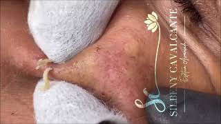 ACNE TREATMENT  Super Satisfying blackheads  004 [upl. by Matheson550]