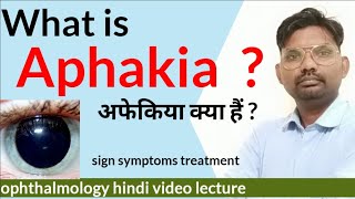 aphakia treatment  what is aphakia  aphakia and Pseudophakia  aphakia ophthalmologyhindi [upl. by Jonna404]