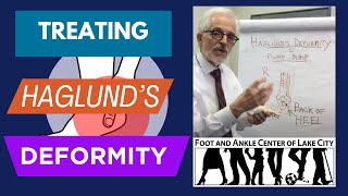 What Is Haglunds Deformity and How Is it Treated [upl. by Edivad]