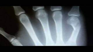 Metacarpal Fracture Symptoms XRay Findings Treatment [upl. by Ahsiral]