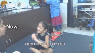 Dystonic Cerebral Palsy New Treatment Results  Quick Look [upl. by Goda548]