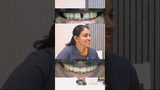 teeth gap  teeth gap filling  Composite filling [upl. by Nyrrat]