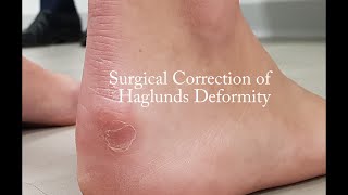 Surgical Correction of Haglunds Deformity [upl. by Cruce]