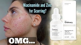 I TESTED THE ORDINARY NIACINAMIDE AND ZINC SERUM FOR MY ACNE SCARS ONE MONTH Shocked by this [upl. by Tnairb]