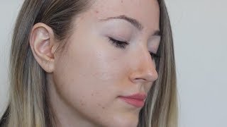 THE TRUTH WHY ACCUTANE DIDNT WORK [upl. by Tamarra439]