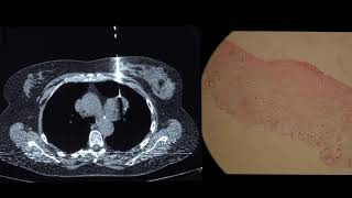 Pulmonary hamartoma a benign chest mass [upl. by Downey675]