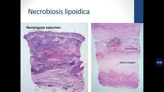 Basic Dermatopathology 11 Granulomatous [upl. by Kries]